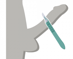 切る包茎手術