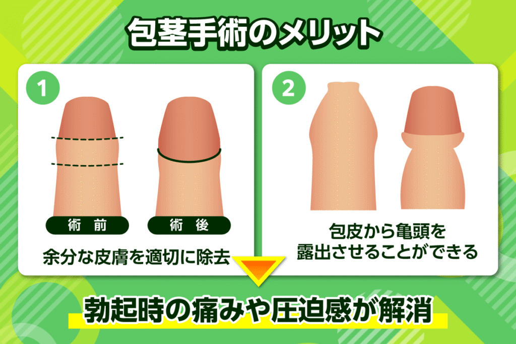 包茎手術を受けるメリットは勃起時の傷みや圧迫感が解消されること