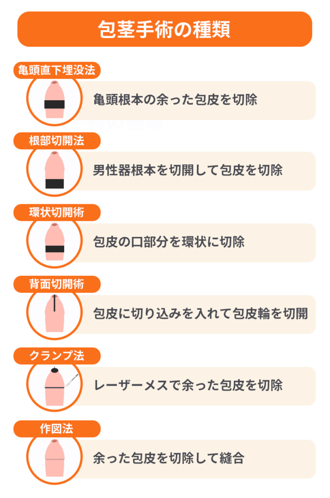 包茎手術の種類6つを解説した画像