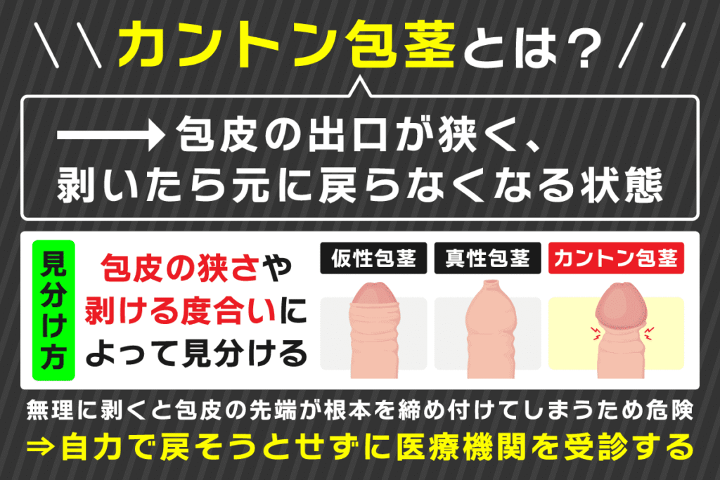 カントン包茎の見分け方について解説した画像